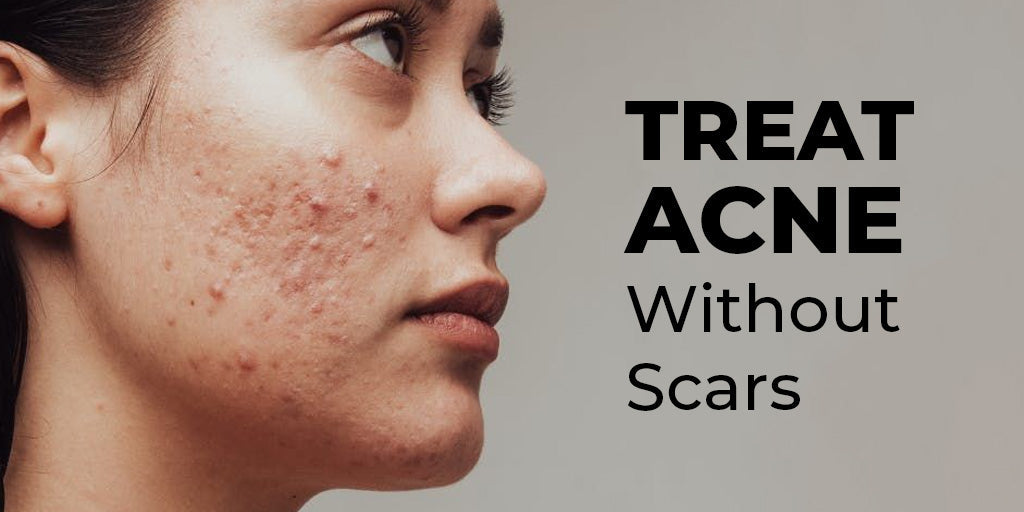 How to Treat Acne Without Dark Marks or Scars
