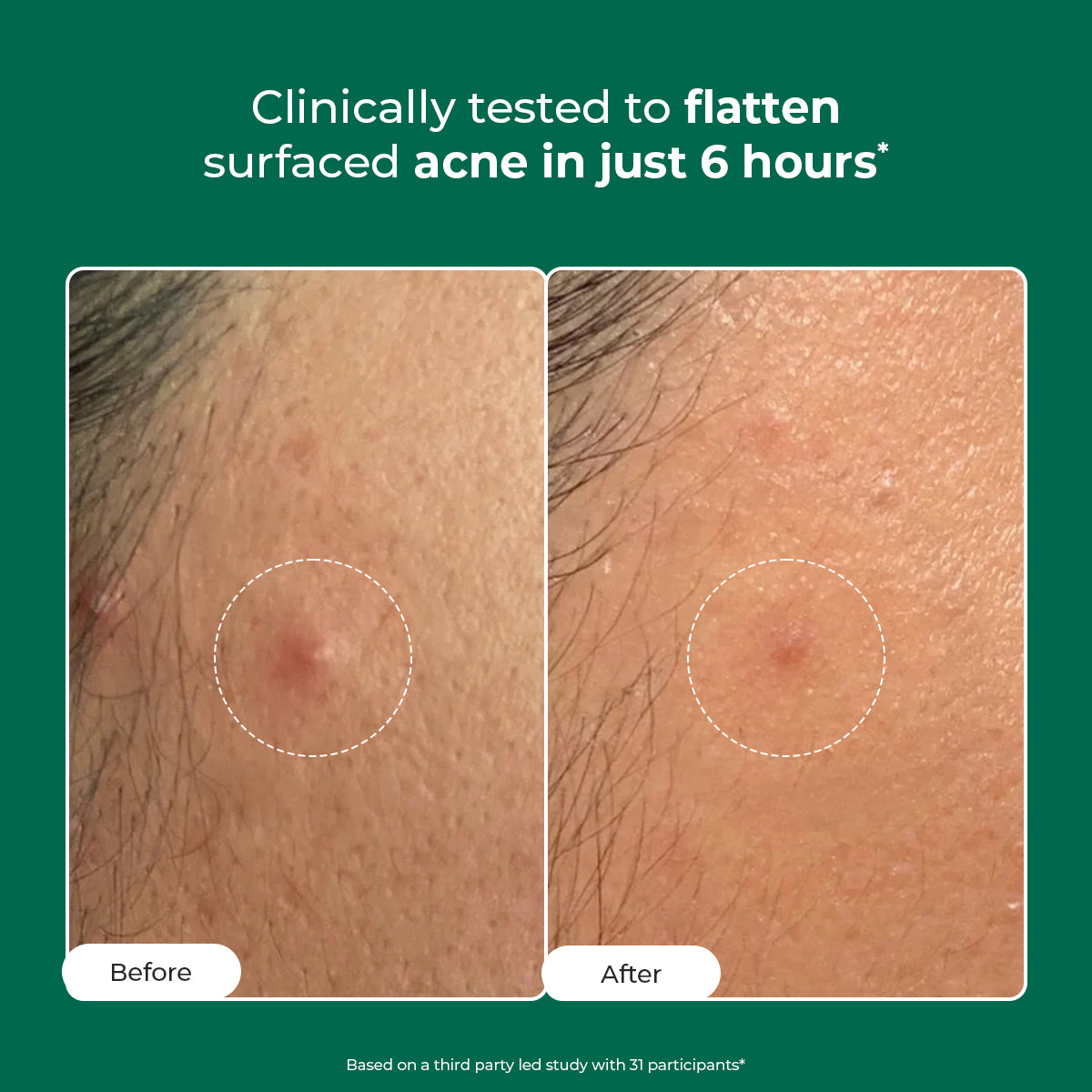 Self Dissolving Microneedle Acne Patches | 8 Patches