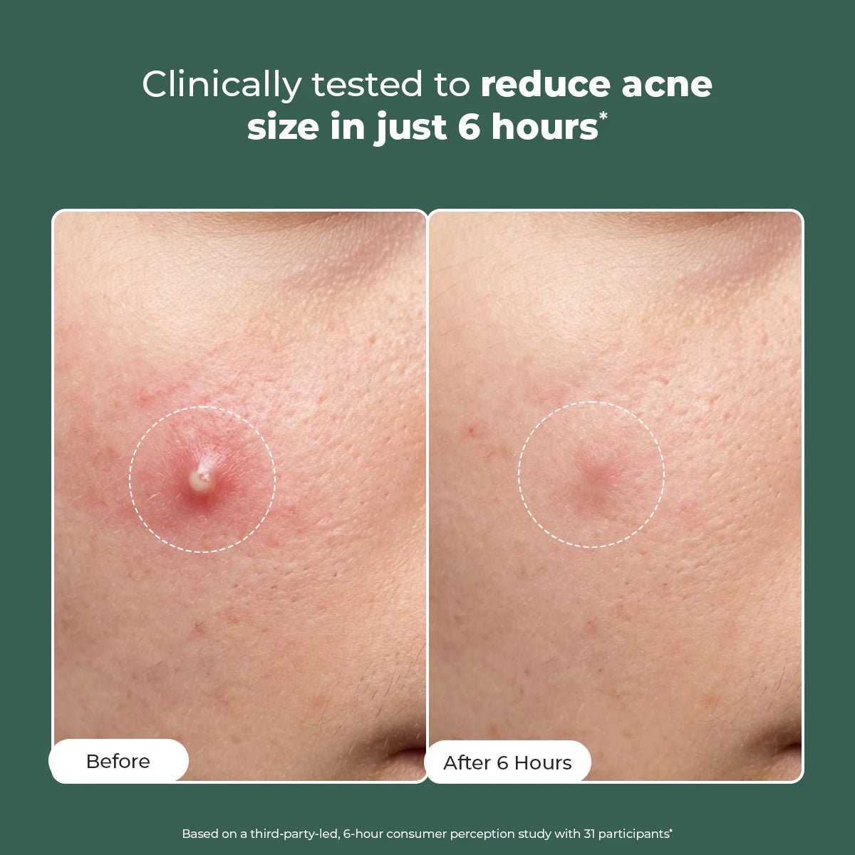 Acne Spot Corrector Gel | 15 ml