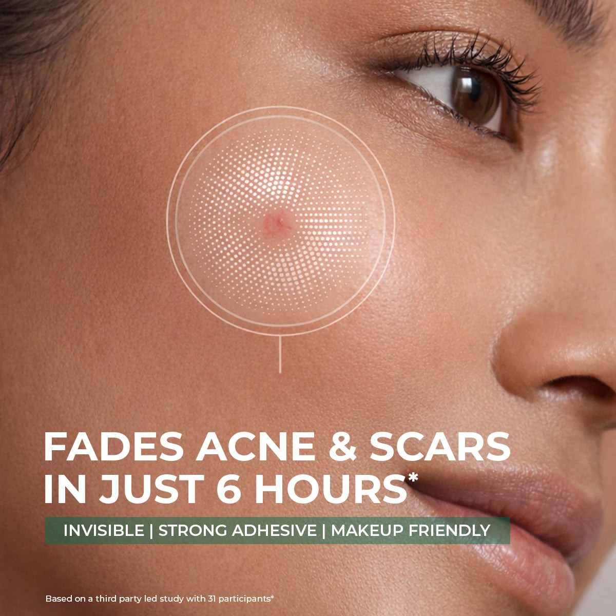Self Dissolving Microneedle Acne Patches | 8 Patches