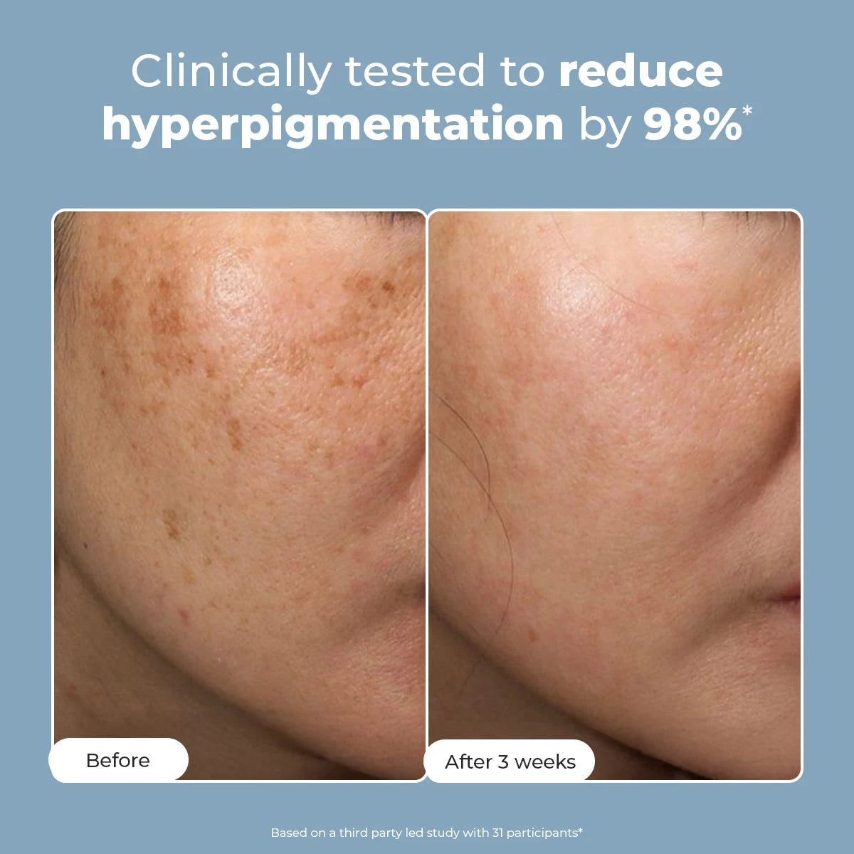 Trubiom Pigmentation & Dark Spots Treatment Serum | 30 ml