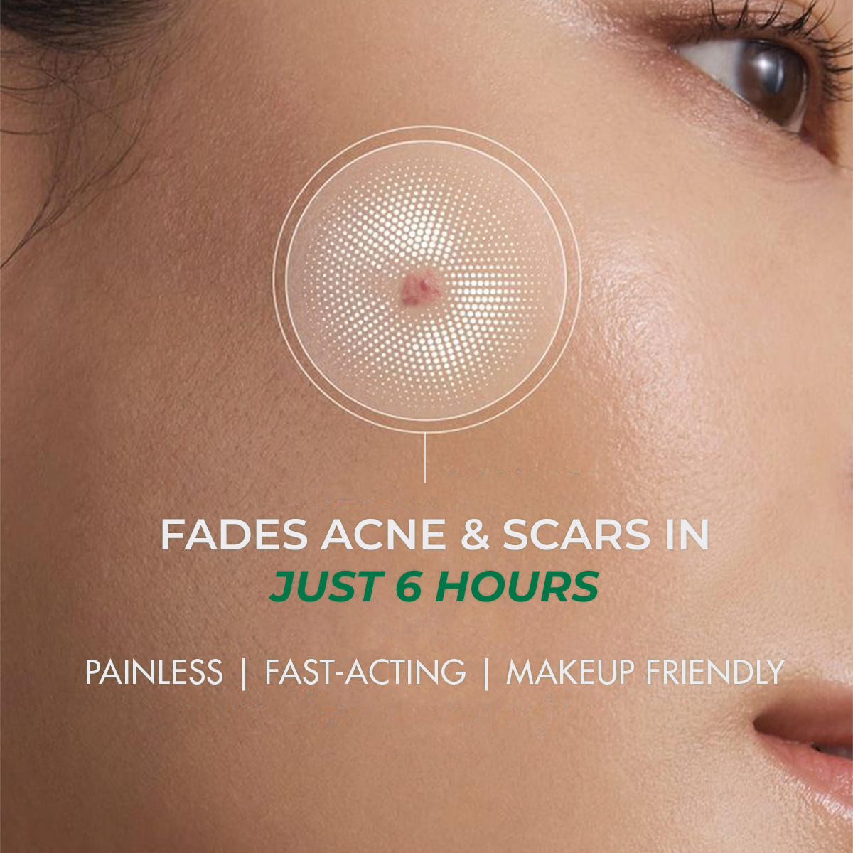 Self Dissolving Microneedle Acne Patches | 8 Patches