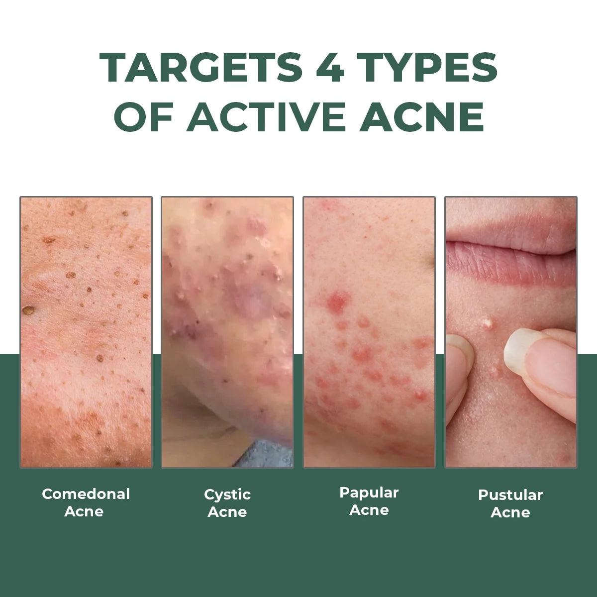 Acne Spot Corrector Gel