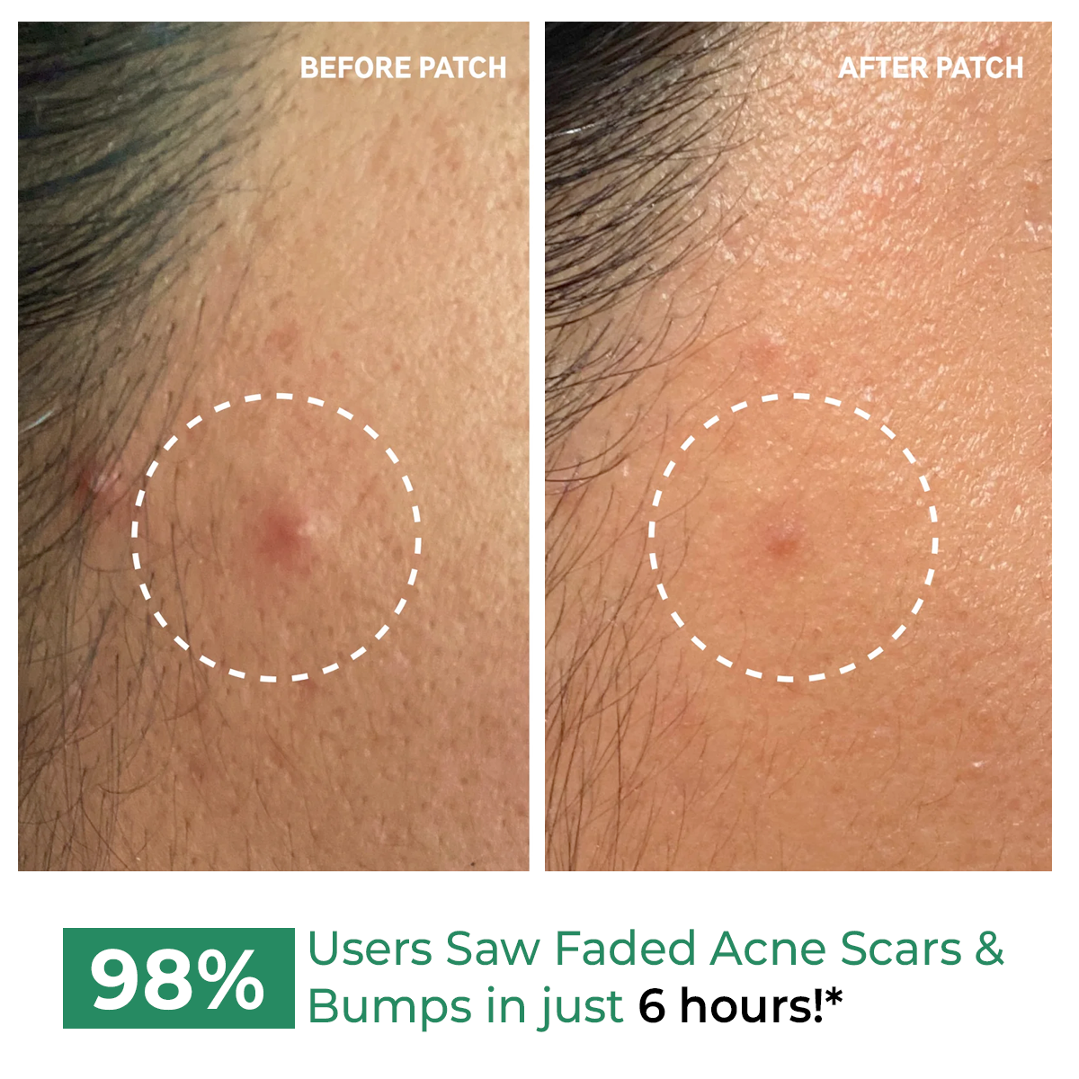 Self Dissolving Microneedle Acne Patches | 8 Patches