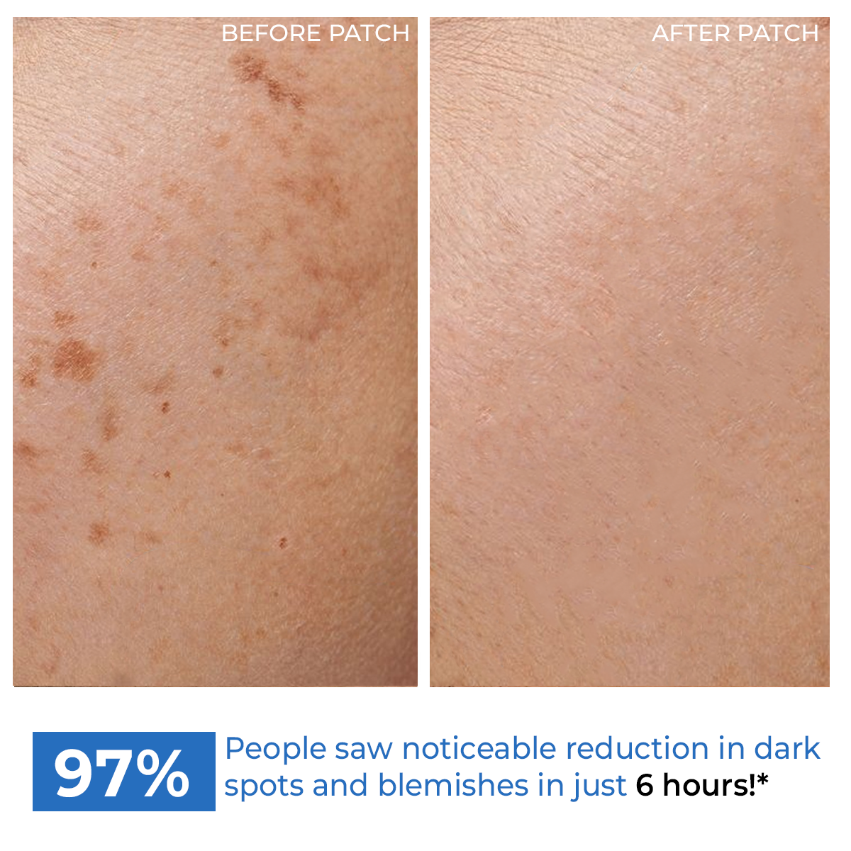 Microneedle Patch For Dark Spot Removal | 4 Patches