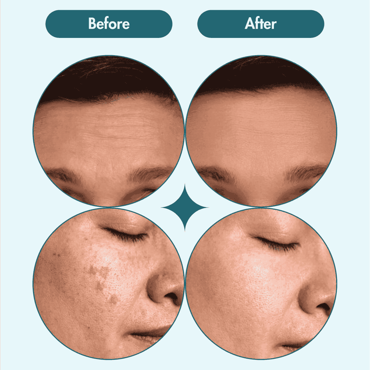Pack Of Two - Pigmentation & Dark Spot Corrector Gel Cream | Kojic Acid & Niacinamide | 100 gms