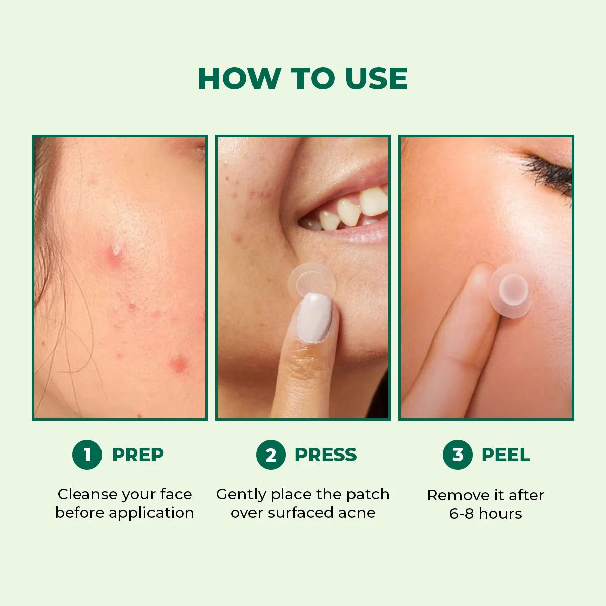 Self Dissolving Microneedle Acne Patches | 8 Patches