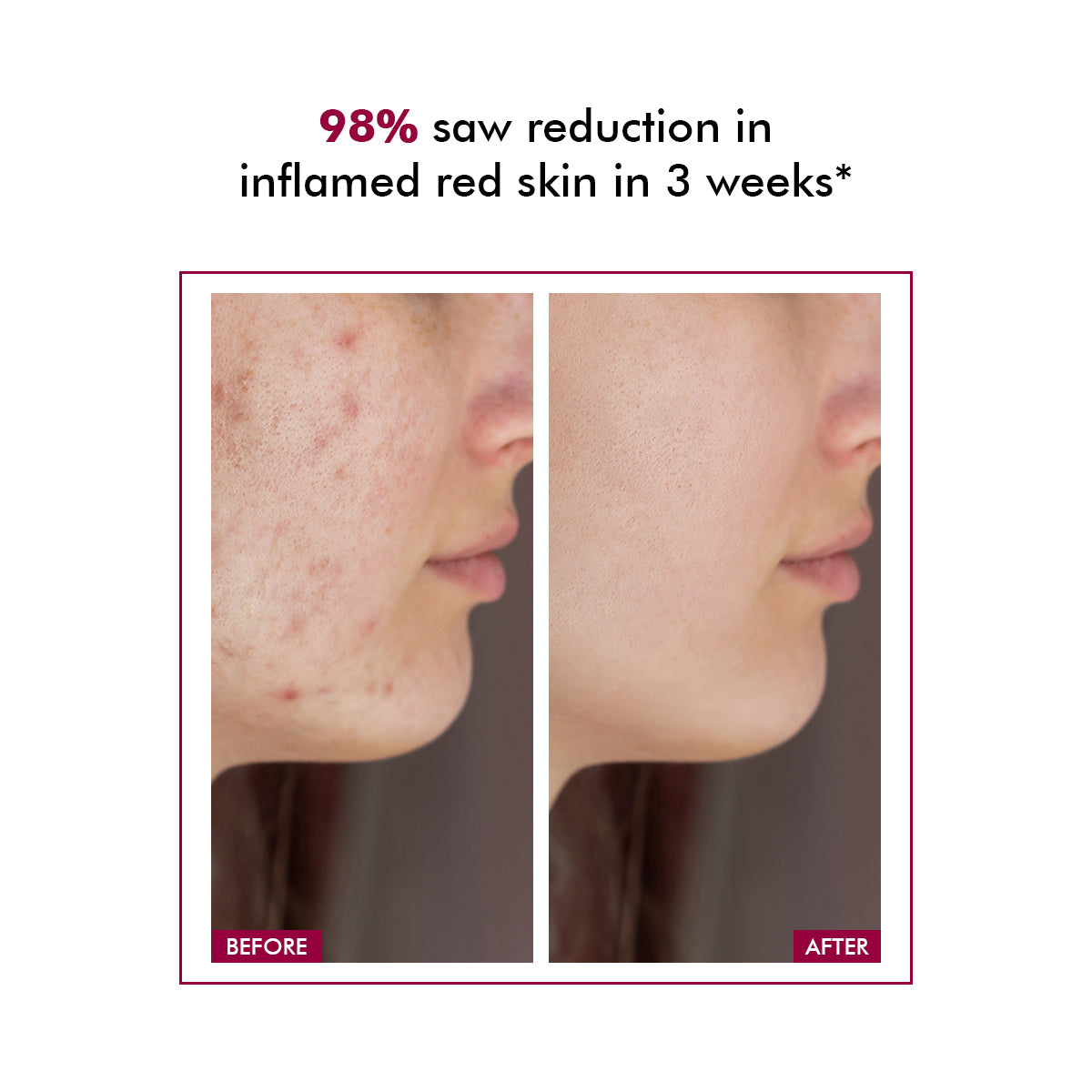 Azicalm Redness & Inflammation Relief Cream | 10% Azelaic Acid | 50 gms