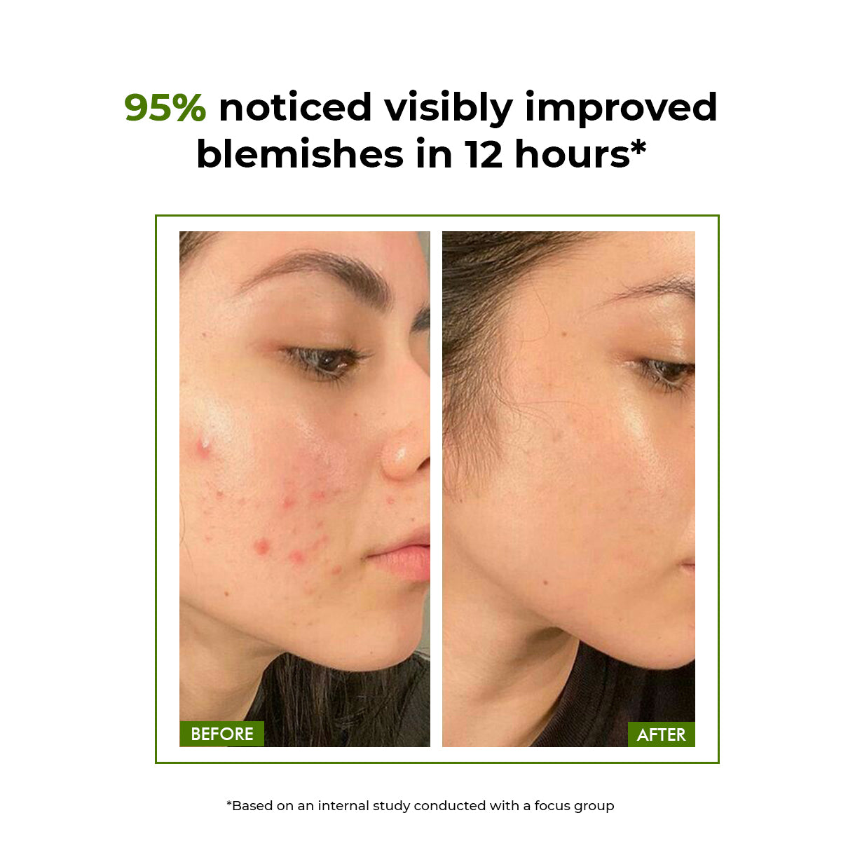 Flashfix Acne Control Oil - Free Gel Cream | 50 gm