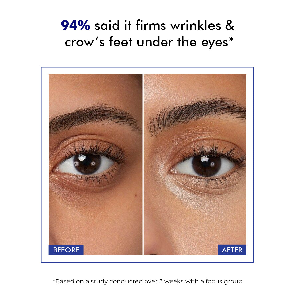 Eye Treatment Serum | Treats Dark Circles & Fine Lines | 15 ml