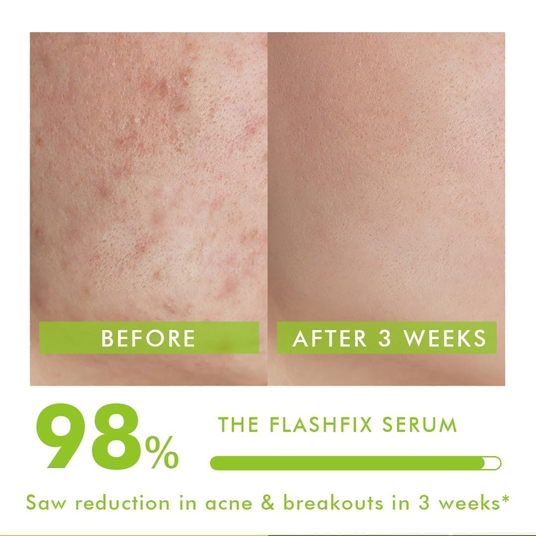 Acne Routine Kit Pack Of 3