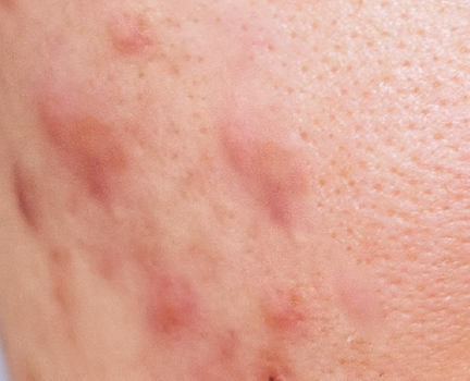 Conscious Chemist use case: intensive care for active and inflamed acne