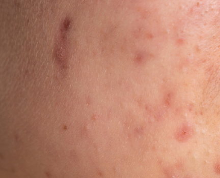 Conscious Chemist skincare concern: active acne and pigmentation