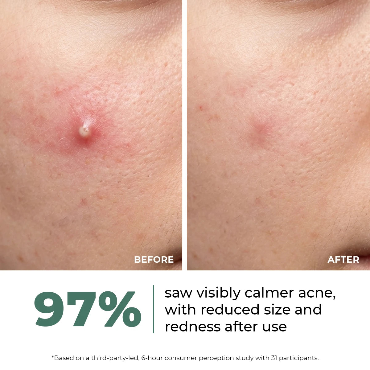 Acne Spot Corrector Gel | 15 ml