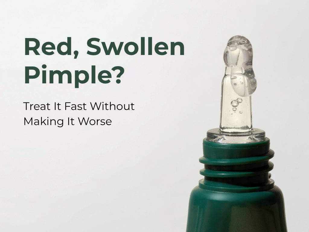 How to Treat Acne Overnight and Reduce Redness Fast?