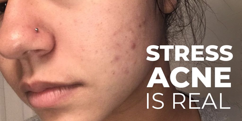 Stress Acne Is Real: Here’s How to Treat and Calm It Fast