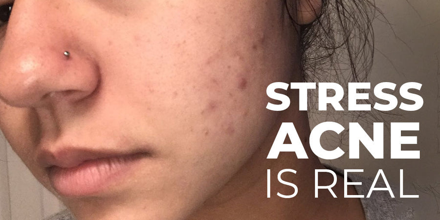 Stress Acne Is Real: Here’s How to Treat and Calm It Fast