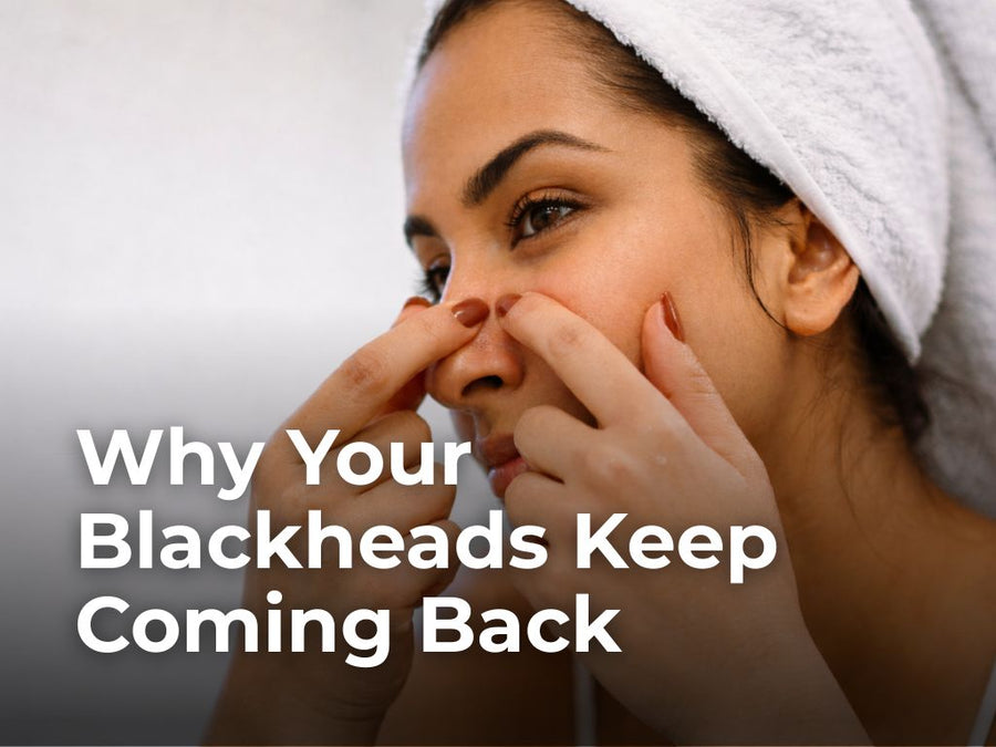 How to Prevent Blackheads From Returning?