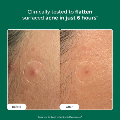 Self Dissolving Microneedle Acne Patches | 8 Patches | Super Saver Sale