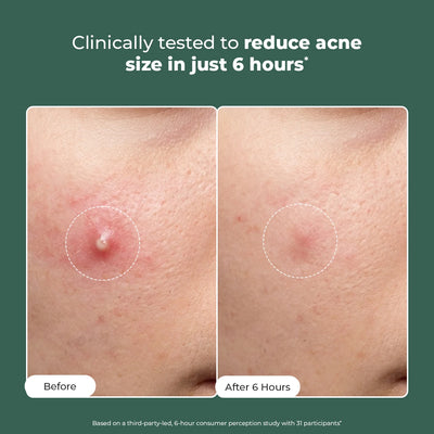 Acne Spot Corrector Gel