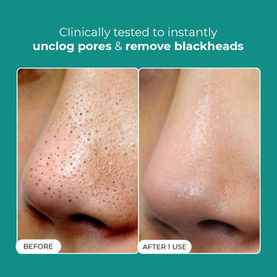 Blackhead Removal Combo | 2x50 ml + 1 Toolkit | Super Saver Sale