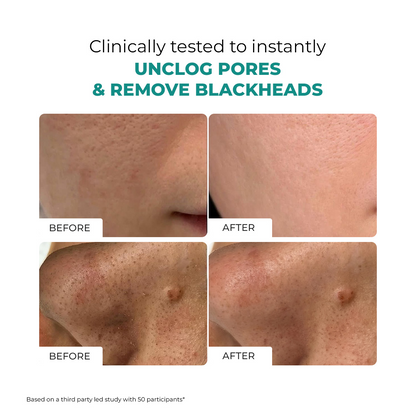 Blackhead Melting Water
