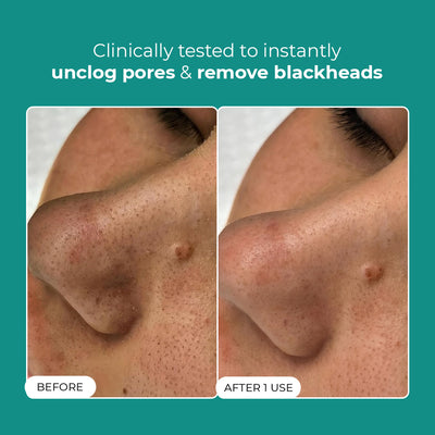 Blackhead Removal Combo | Blackhead Melting Water Mini (Pack of 2) + Blackhead Remover Toolkit | 2x50 ml + 1 Toolkit