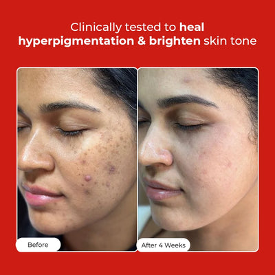 5 Antioxidant Skin Brightening Serum | Super Saver Sale