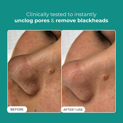 Blackhead Melting Water + Toolkit |  130 ml + 1  Nos.
