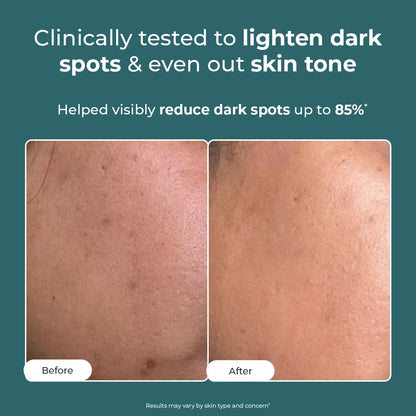 Trubiom Dark Spot Corrector Gel Cream | 50 gms | Flash Sale
