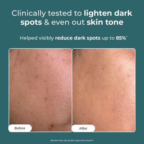 Trubiom Dark Spot Corrector Gel Cream | 50 gms | Flash Sale