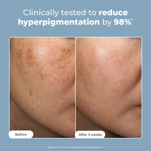 Trubiom Pigmentation & Dark Spots Treatment Serum | 30 ml | Flash Sale