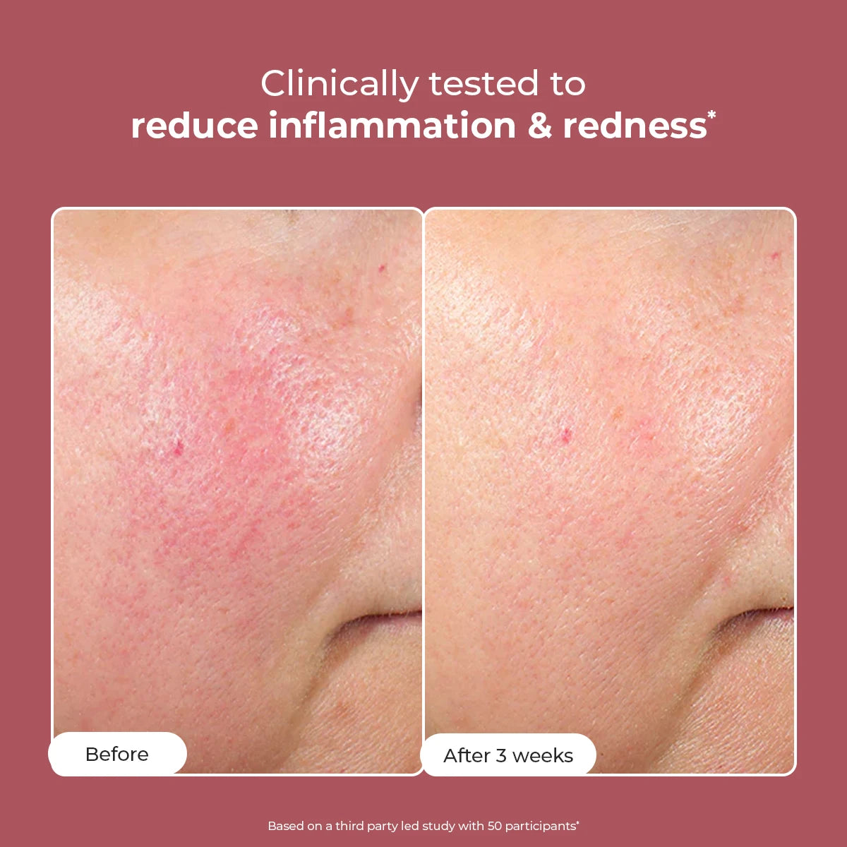 Azicalm Redness & Inflammation Relief Cream |  10% Azelaic Acid | 50 gms