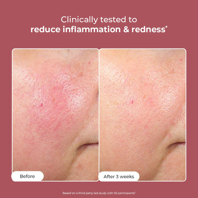 Azicalm Redness & Inflammation Relief Cream |  10% Azelaic Acid | Super Saver Sale
