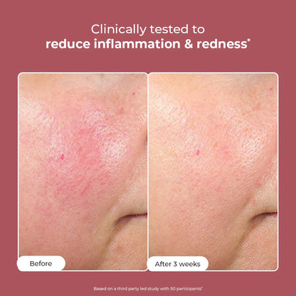 Azicalm Redness & Inflammation Relief Cream |  10% Azelaic Acid | 50 gms