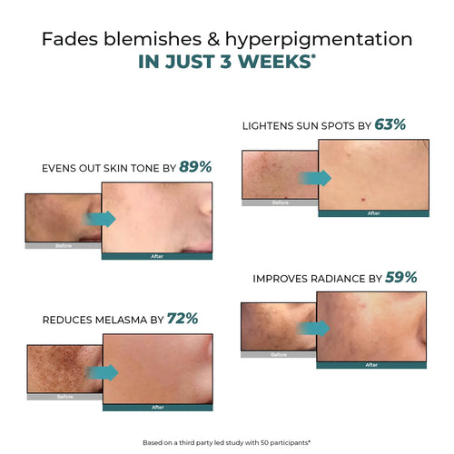 Trubiom Pigmentation & Dark Spots Treatment Serum | 30 ml | Flash Sale