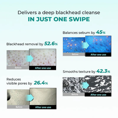 Blackhead Removal Combo | 2x50 ml + 1 Toolkit | Super Saver Sale