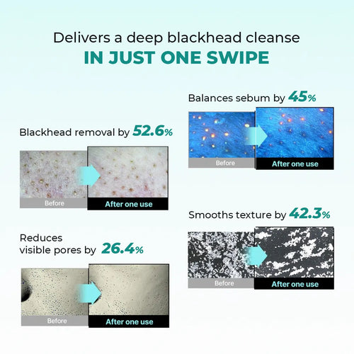 Blackhead Melting Water | 130 ml | Flash Sale