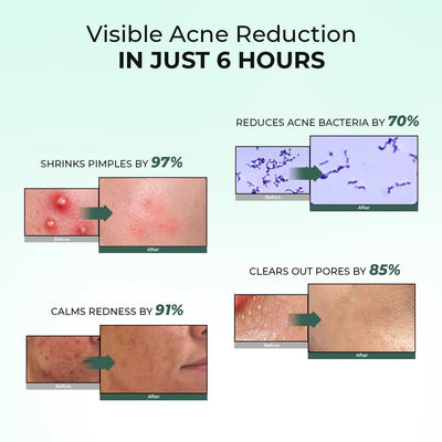 Acne Spot Corrector Gel