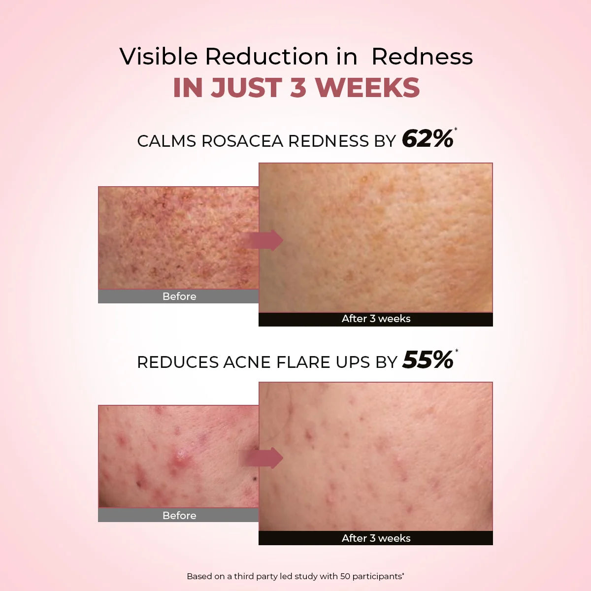 Azicalm Redness & Inflammation Relief Cream |  10% Azelaic Acid | 50 gms