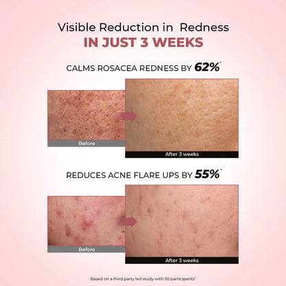 Azicalm Redness & Inflammation Relief Cream |  10% Azelaic Acid | 50 gms