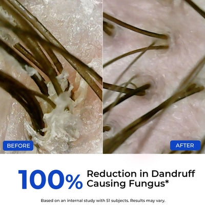 Anti-Dandruff Scalp Exfoliator | Supersaver Sale