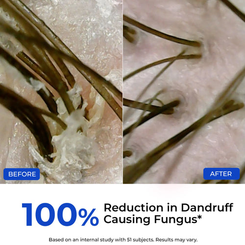 Anti-Dandruff Scalp Exfoliator | Flash Sale