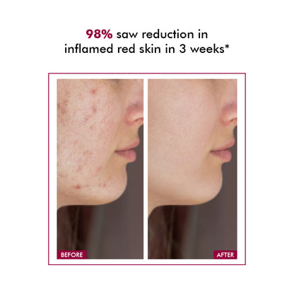 Redness & Inflammation Relief Cream |  10% Azelaic Acid | 50 gm