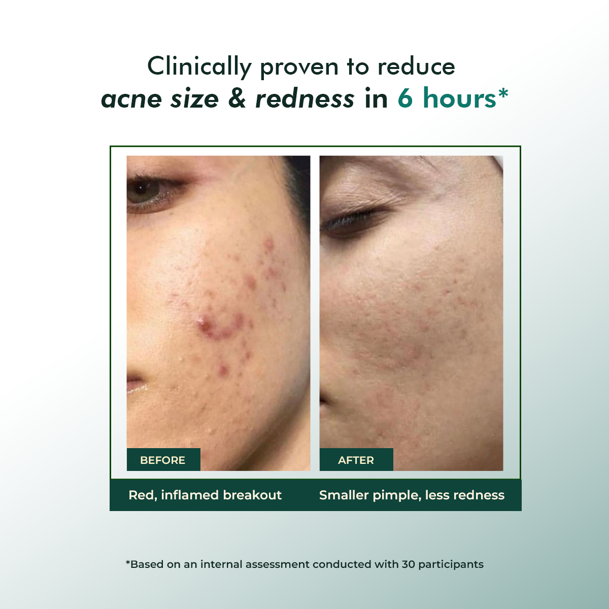 Fast-Acting Acne Spot Corrector Gel | Triple Action Formula