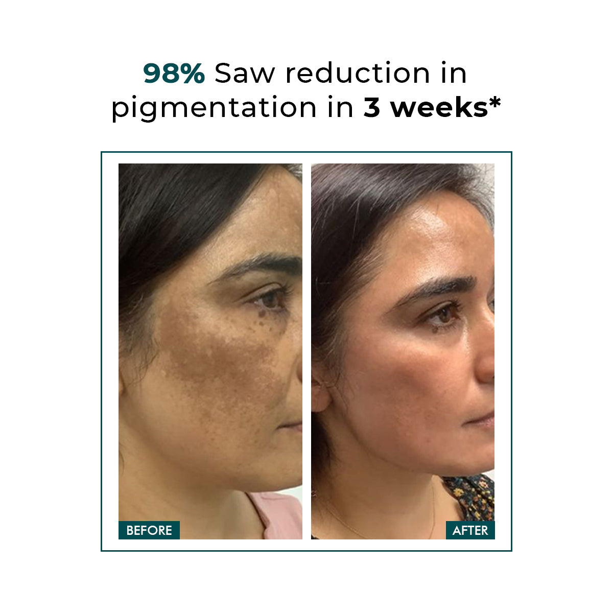 Pigmentation & Dark Spots Treatment | 5%  Niacinamide Serum | 30 ml