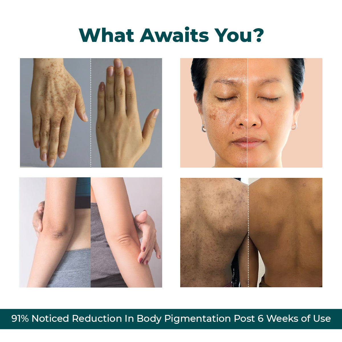 Pigmentation & Dark Spot Corrector Gel Cream | Kojic Acid & Niacinamide | 50 gm