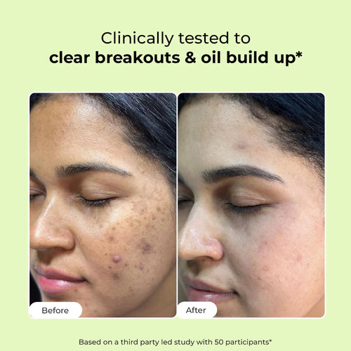 Oil Control & Acne Clearing Exfoliating Face Wash | AHA, BHA & CICA Extract | 100 ml | Flash Sale