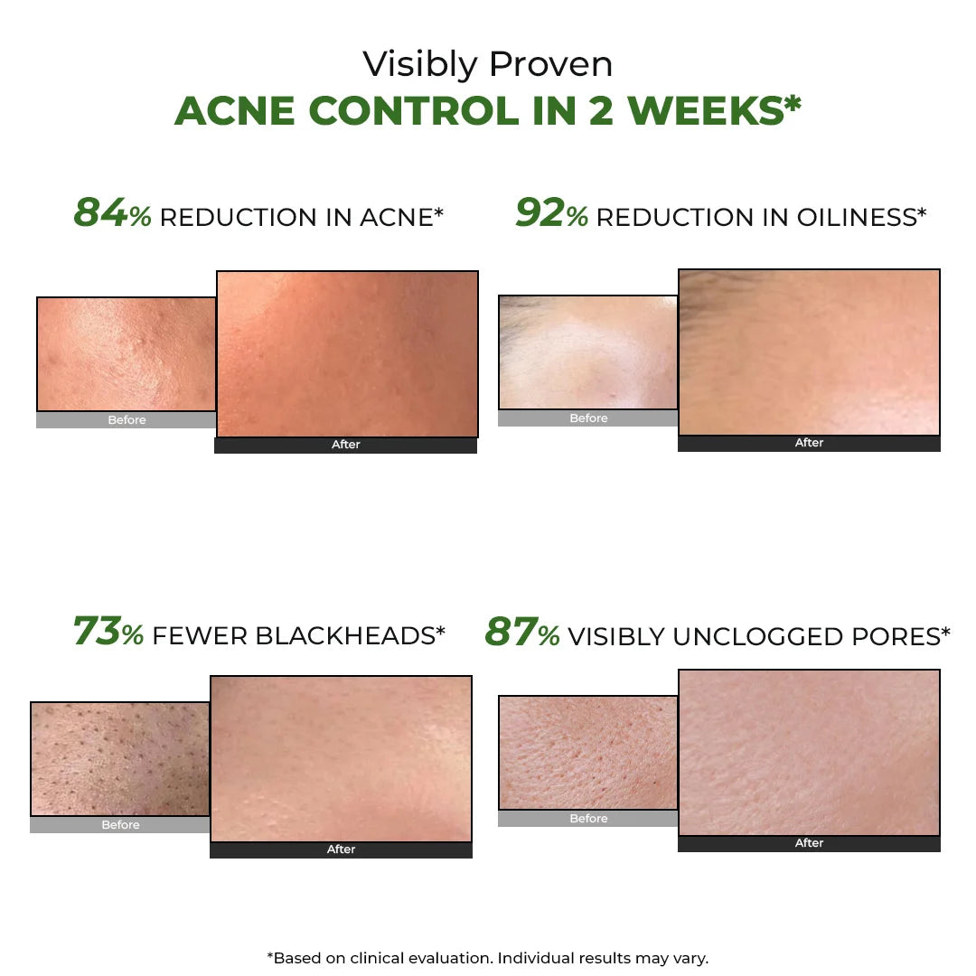 Flashfix Acne Control Oil - Free Gel Cream
