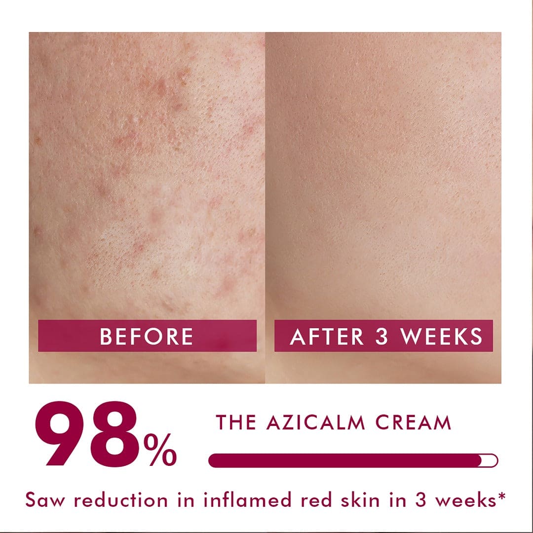 Redness & Inflammation Relief Cream |  10% Azelaic Acid | 50 gm